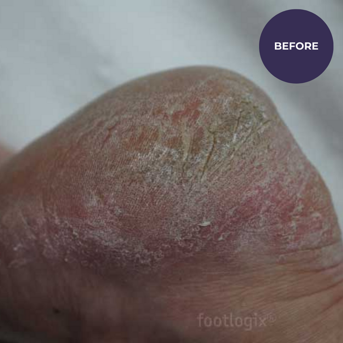 Footlogix DD Cream Mousse – Crema Hidratante Diaria para Pies | 125ml