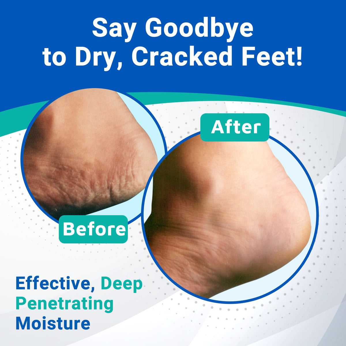 Dermal Therapy Heel Care Cream – 25% Urea & AHAs | Intensive Foot Moisturiser | 3oz